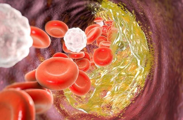 इन लोगों का Cholesterol कभी कंट्रोल में नहीं आता! इन गलतियों से शुरू होती बीमारी