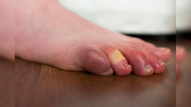 ठंड में उंगलियों की सूजन का पक्का इलाज ,एक्सपर्ट ने बताया कैसे पाएं तुरंत आराम