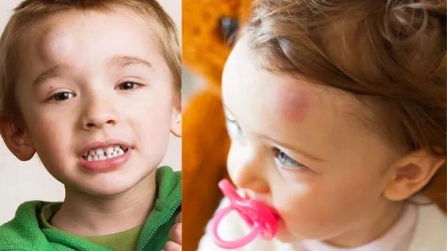 पेरेंट्स हो जाएं सावधान: बच्चों में फेला गंभीर सिंड्रोम, चेहरे और आंखों पर सूजन के लक्षण