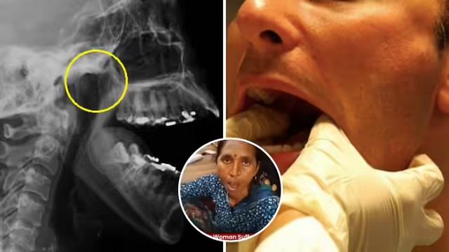 एक निवाला लेते ही dislocated हुआ जबड़ा, खुला रह गया मुंह,न करें ये 5 गलतियां