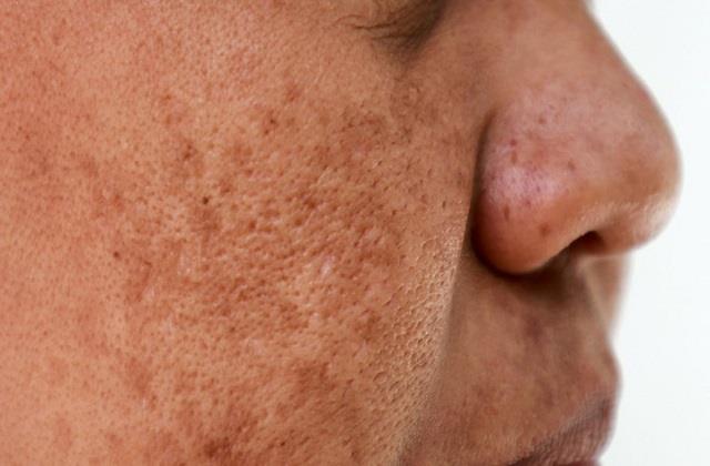 किन Vitamins की कमी से होती हैं चेहरे पर झाइयां? जानें कारण, लक्षण और उपाय