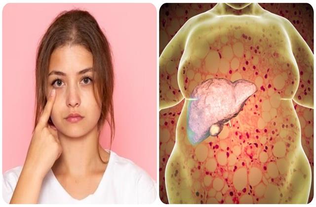 चेहरे के ये  5 संकेत देते हैं Fatty Liver का अलर्ट, तुरंत पहचानें खतरा