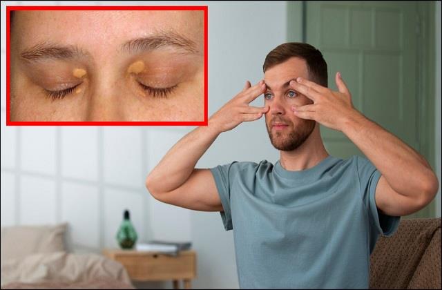 पलकों पर दिख रहे ये बदलाव हो सकते हैं High Cholesterol के लक्षण