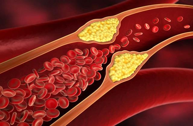 गंदे Cholesterol के लिए दवाइयों के भरोसे ना बैठें, ये खाएं और हफ्ते में Result पाएं