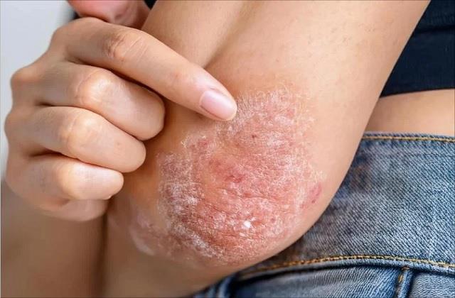 सर्दी में स्किन पर दिखें ये पपड़ी जैसे निशान तो तुरंत डॉक्टर को दिखाएं, लापरवाही पड़ेगी भारी!