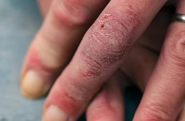 ठंड में गलने-सूजने लगती हैं हाथ-पैर की उंगलियां तो ये काम जरूर करें