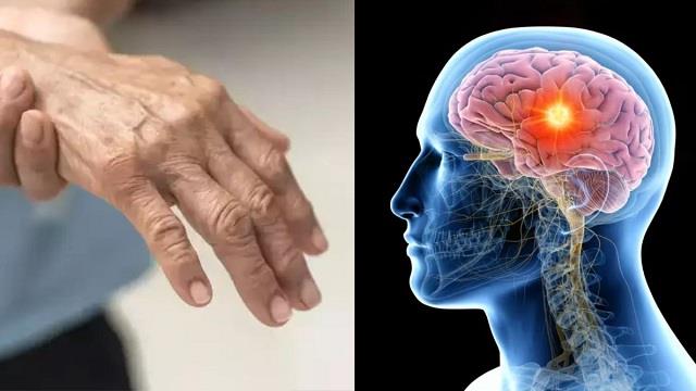 100 से ज्यादा मामले! पुणे में तेजी से फैल रहा खतरनाक GBS Syndrome, जानिए बचाव के तरीके