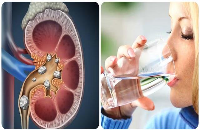 एक-दो नहीं इन 4 तरीकों से किडनी पर अटैक कर सकती है पथरी, पानी ही है Stone का सबसे बड़ा दुश्मन