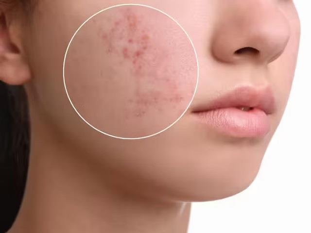 चेहरे पर पिंपल्स? ये 5 आसान Tips आपकी Skin को बनाएंगे बेदाग!