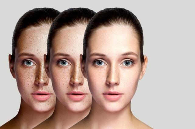 चेहरे पर लगाएं ये एक चीज़, पिगमेंटेशन की समस्या होगी छूमंतर