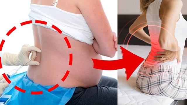 क्या सी-सेक्शन के इंजेक्शन से होती है उम्रभर कमर दर्द?