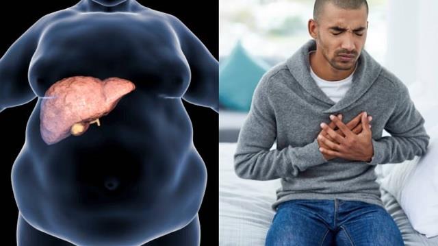 क्या फैटी लिवर से हार्ट अटैक आ सकता है? जानिए क्या कहते हैं एक्सपर्ट्स