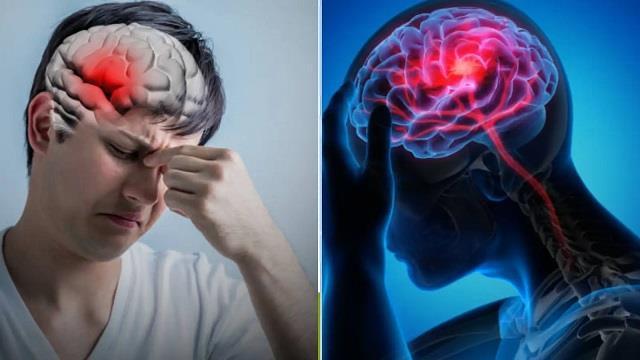 Brain Stroke आने से पहले शरीर देता है चेतावनी, एक्सपर्ट ने बताया कैसे बचें