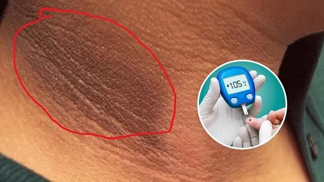सिर्फ प्यास या पेशाब नहीं, गर्दन पर दिखने वाला ये अजीब लक्षण भी हो सकता है डायबिटीज का संकेत