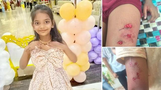 कुत्ते के काटने के 25 दिन बाद सात साल की बच्ची की मौत, एंटी-रेबीज की तीसरी डोज से पहले बिगड़ी तबीयत