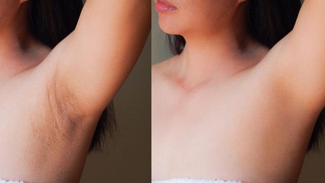 अब स्लीवलेस पहनने में न शर्माएं! ये आसान घरेलू नुस्खा करेगा अंडरआर्म्स के कालेपन को दूर