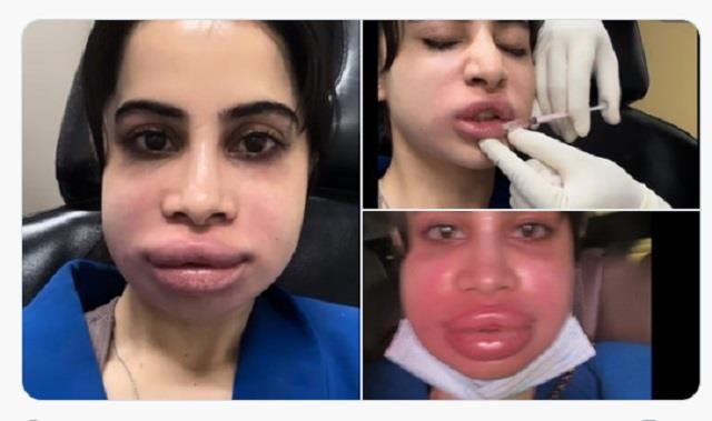 OMG! ये क्या हो गया उर्फी को?  सूजे होंठों की वजह से पैपराजी से छिपाया चेहरा