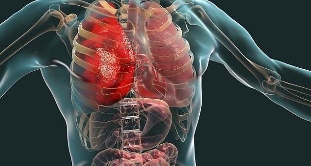 किस बीमारी के चलते होता है मल्टी ऑर्गन फेलियर? जाने यहां