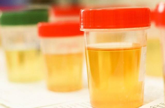 नॉर्मल नहीं है सुबह के समय पीला पेशाब आना, चीख-चीखकर दे रहा है किडनी खराब होने के संकेत