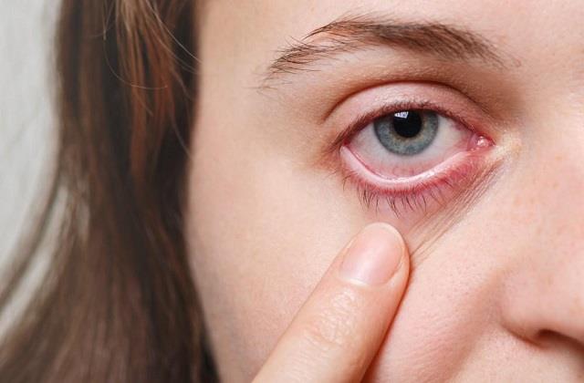 बरसाती मौसम में हो गया है Eye Flu तो ये गलती ना कर बैठें, खासकर बच्चे के साथ...