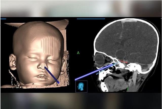 डॉक्टरों ने किया चमत्कार: 2 साल की बच्ची के ब्रेन ट्यूमर की नाक के रास्ते हुई सर्जरी, बचाई जान
