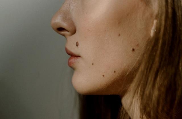 अब अनचाहे तिल नहीं बिगाड़ेंगे खूबसूरती, अपनाएं ये आसान घरेलू नुस्खे