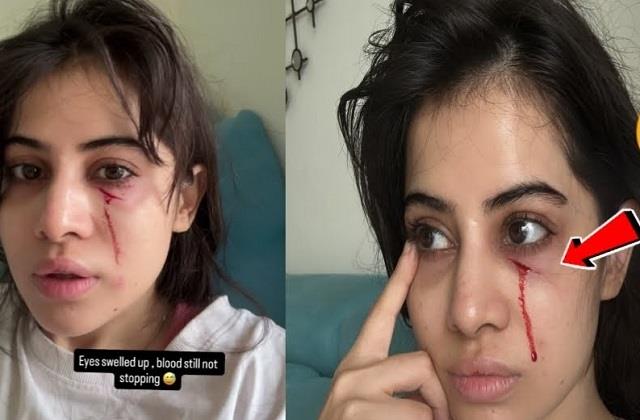 उर्फी जावेद पर बिल्ली ने किया हमला, बुरी तरह घायल हुई एक्ट्रेस ने दिखाया अपना हाल