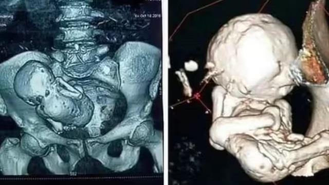 पेट में 40 साल से पल रहा था ‘पत्थर का बच्चा’, डॉक्टर भी देखकर रह गए हैरान