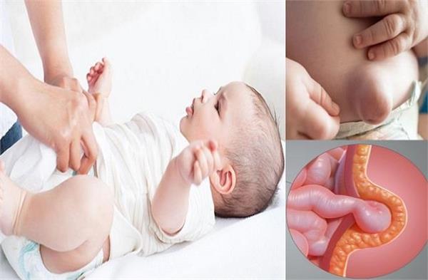 समय से पहले जन्मे बच्चों में हर्निया का खतरा क्यों होता है ज्यादा? डॉक्टर से जानिए कब जरूरी है सर्जरी