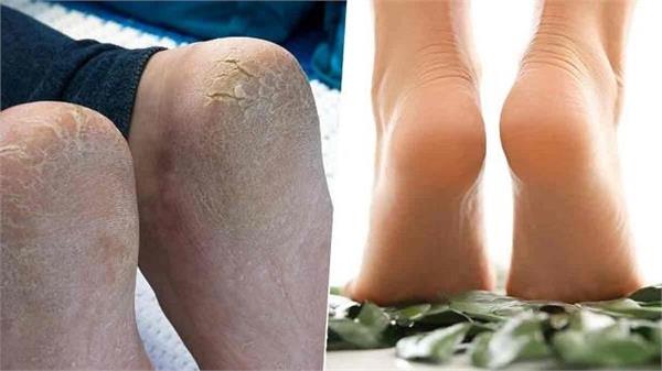 फटी एड़ियों से परेशान? आयुर्वेदिक उपाय से 7 दिन में पाएं मुलायम सुपरसॉफ्ट हील्स!