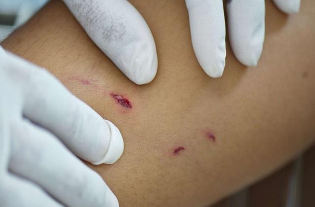 क्या घाव को साबुन से धोने पर खत्म हो जाता है रेबीज का खतरा? जानिए WHO और एक्सपर्ट्स की राय