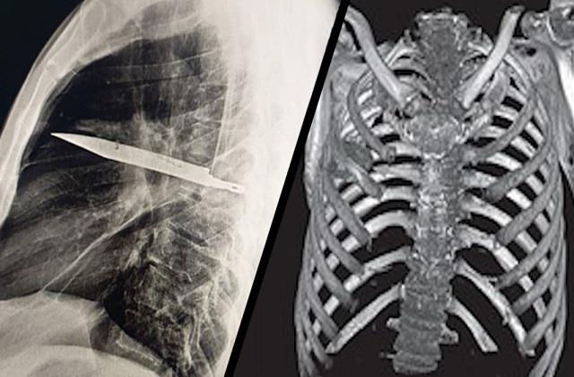 8 साल पहले सीने में फंसा चाकू अब निकाला बाहर, शख्स को अभी तक जिंदा देखकर डॉक्टर भी हैरान