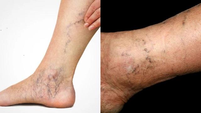 अगर दिखें ये 10 लक्षण तो समझ लीजिए नसें हो रही ब्लॉकेज , तुरंत लें डॉक्टरी इलाज