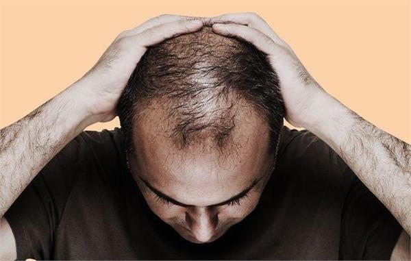 गंजेपन की वजह बन सकती है लिवर की ये बीमारी! युवाओं पर मंडरा रहा है खतरा, स्टडी में हुआ बड़ा खुलासा