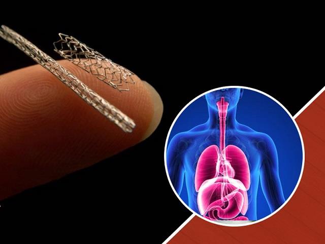 दिल में स्टेंट डालने के बाद बदलें ये आदतें, हार्ट अटैक से मिल सकती है हमेशा के लिए राहत!