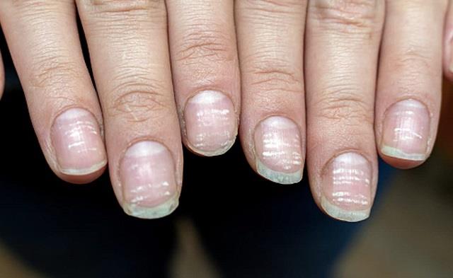 क्या आपके नाखूनों पर भी दिख रहे हैं ये निशान? तो समझ लीजिए इस विटामिन की हो गई कमी