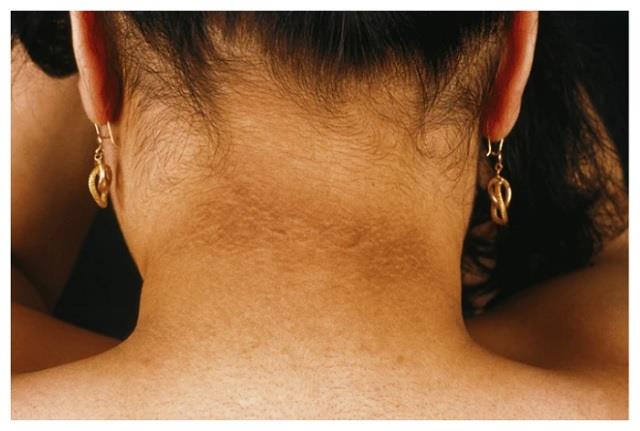 गर्दन के आसपास पर काला घेरा?  तो समझ लें  ये बीमारी  बॉर्डर लाइन पर...