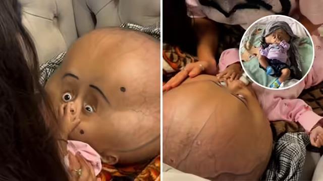 बच्ची को हुई दुर्लभ बीमारी, गुब्बारे की तरह सिर फूला और हाथ-पैर छोटे, Video देख आ जाएंगे आंसू