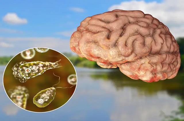 बचकर रहिए दिमाग को खाने वाली बीमारी से, बुखार, सिरदर्द और उल्टी के बाद सीधे हो जाती है मौत