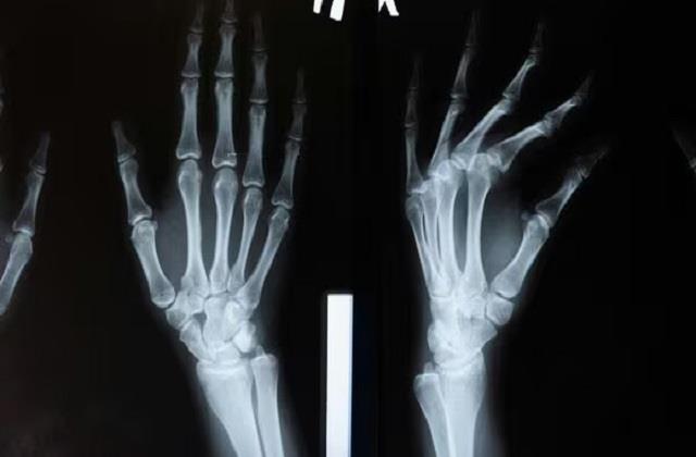वैज्ञानिकों का कमाल ! अब  टूटी हुई हड्डी को जोड़ने में लगेंगे सिर्फ 3 मिनट
