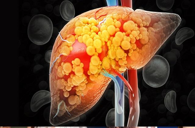 Fatty Liver के 5 लक्षण न करें नजरअंदाज! आंख और नाखून सबसे पहले बताते शरीर का हाल