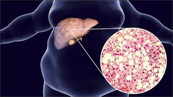 ज्यादा मीठा खाने से Liver पर क्या पड़ता है असर? डॉक्टर से जानें
