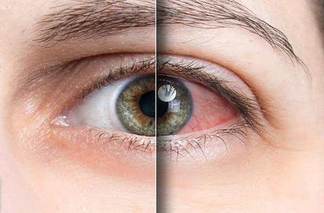 धीरे-धीरे आंखों की रोशनी छीन सकती है यह बीमारी, समय रहते पहचानें Glaucoma के संकेत