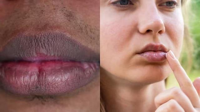 गुलाबी होंठ अब होने लगे काले? जानें Lip Pigmentation के कारण और होंठों को काला पड़ने से कैसे बचाएं