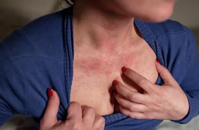 Tension के कारण शरीर पर चकत्ते पड़ जाएं तो क्या करें? जानें Stress Rash का इलाज