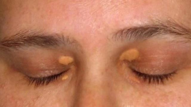 चेहरे पर पीले धब्बे? सतर्क हो जाएं, आंखें दे रही कोलेस्ट्रॉल बढ़ने का इशारा