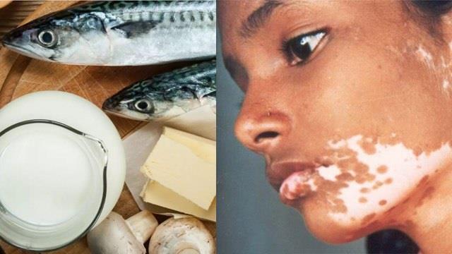 मछली खाने के बाद दूध पीने से सच में हो जाते हैं सफेद दाग? वजह जानकर चौंक जाएंगे आप