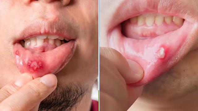 मुंह में छाले किस विटामिन की कमी से होते हैं? एक्सपर्ट ने बताए दर्द से राहत पाने के नेचुरल तरीके