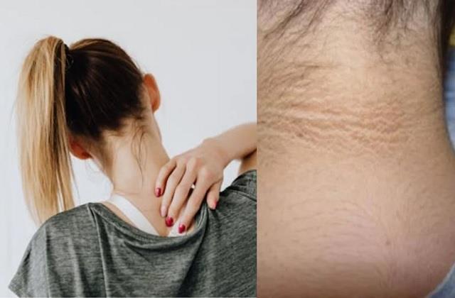गर्दन पर काली लाइन सिर्फ गंदगी नहीं, हो सकती है गंभीर और जानलेवा बीमारियों का संकेत