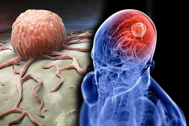 ये लक्षण दिखें तो है ब्रेन ट्यूमर का खतरा, भूलकर भी न करें नजरअंदाज